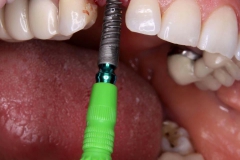 Klempka-Dental-Implants-1