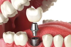 Klempka-Dental-Implants-2