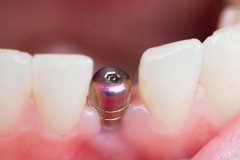 Klempka-Dental-Implants
