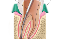 Klempka-Dental-Endodontics-1