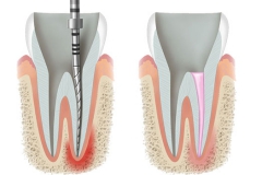Klempka-Dental-Endodontics