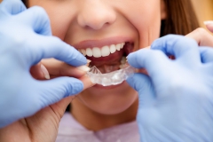 Klempka-Dental-invisalign-1