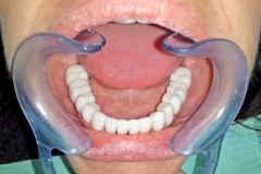 Klempka-dental-Prothetics-2