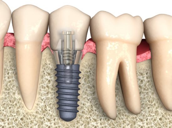 dental implant chicago il