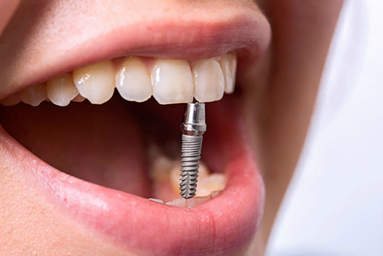 dental implant service chicago